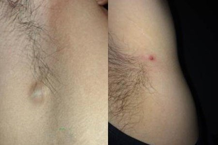 【图】腋窝下小疙瘩是什么引起的知道这些让你不再担忧(图2)